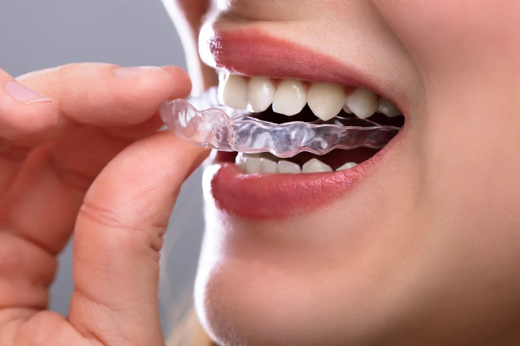 Braces & Aligners