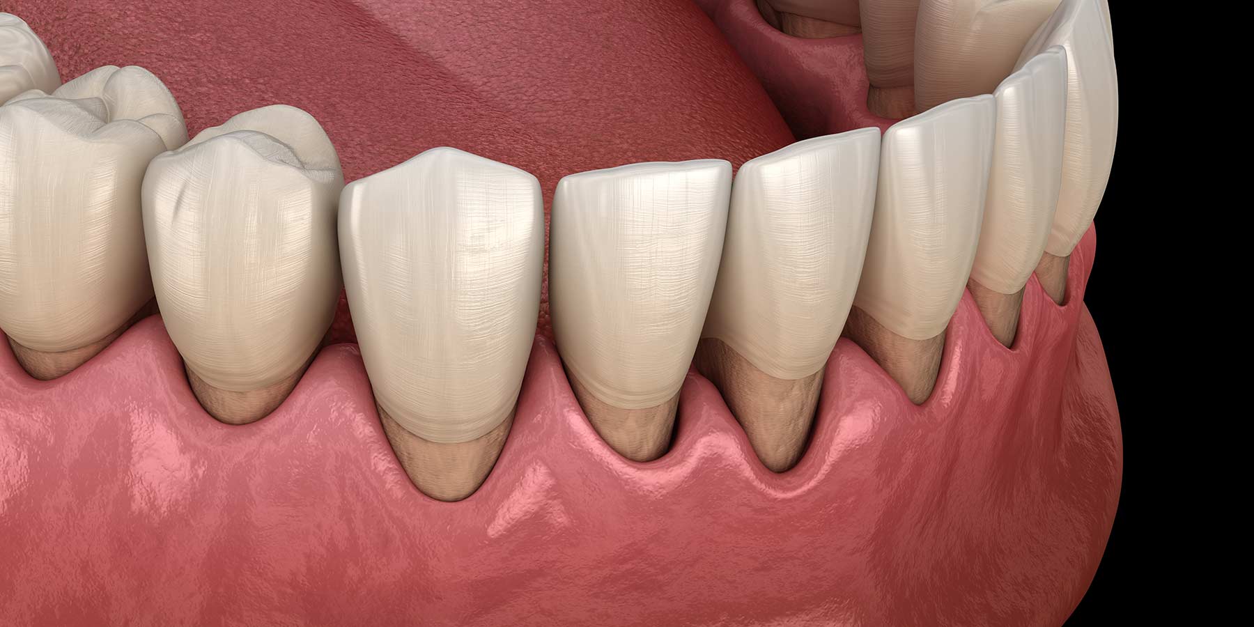 Gum Treatment