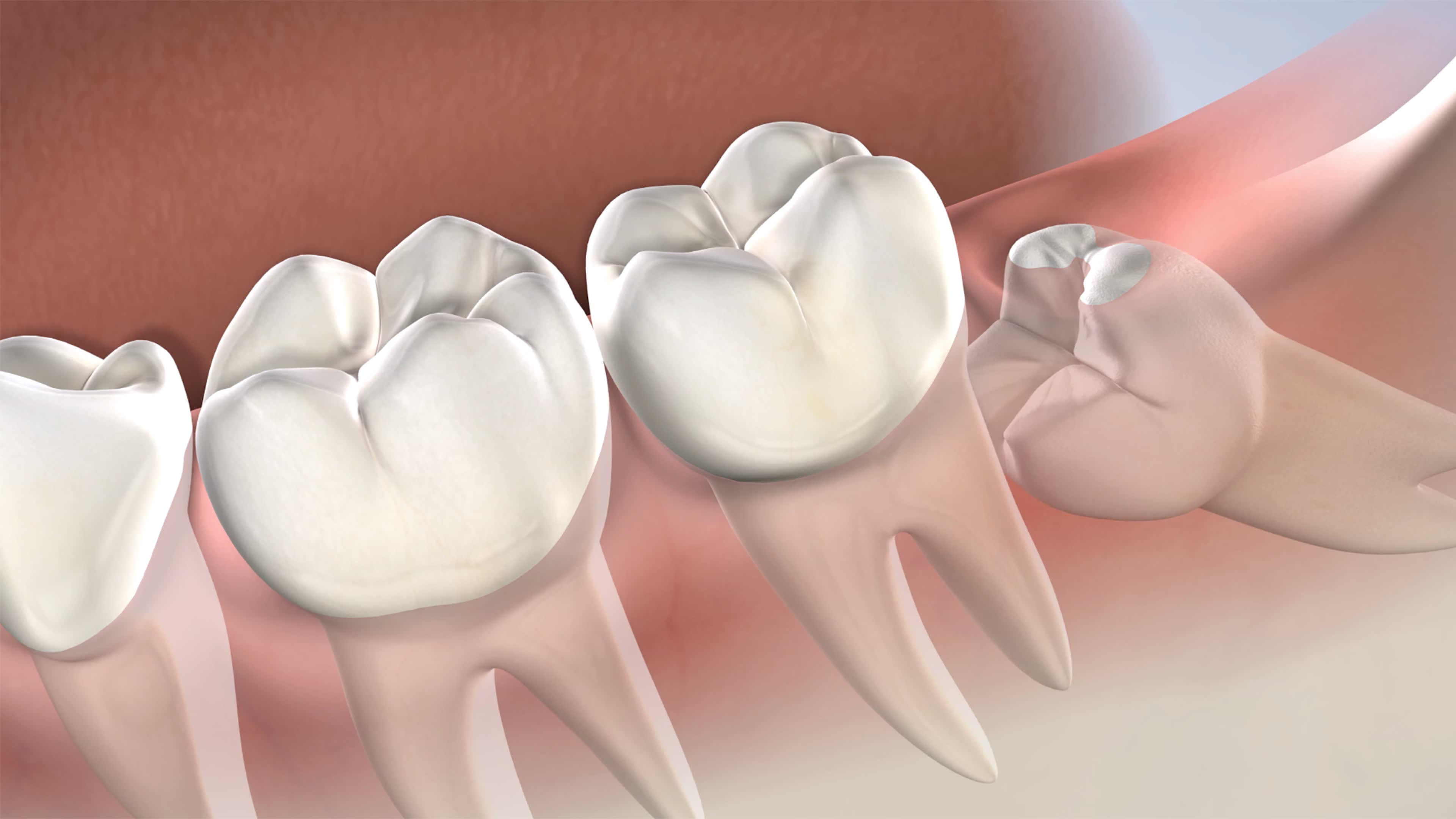 Wisdom Tooth Removal